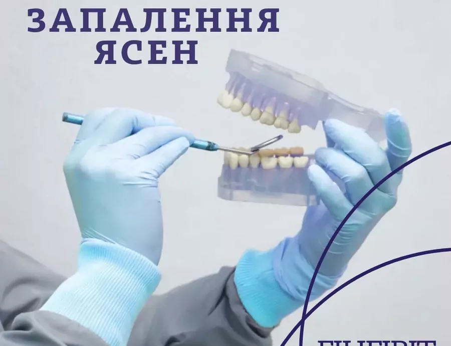 Гінгівіт: чому запалюються ясна і як це лікувати