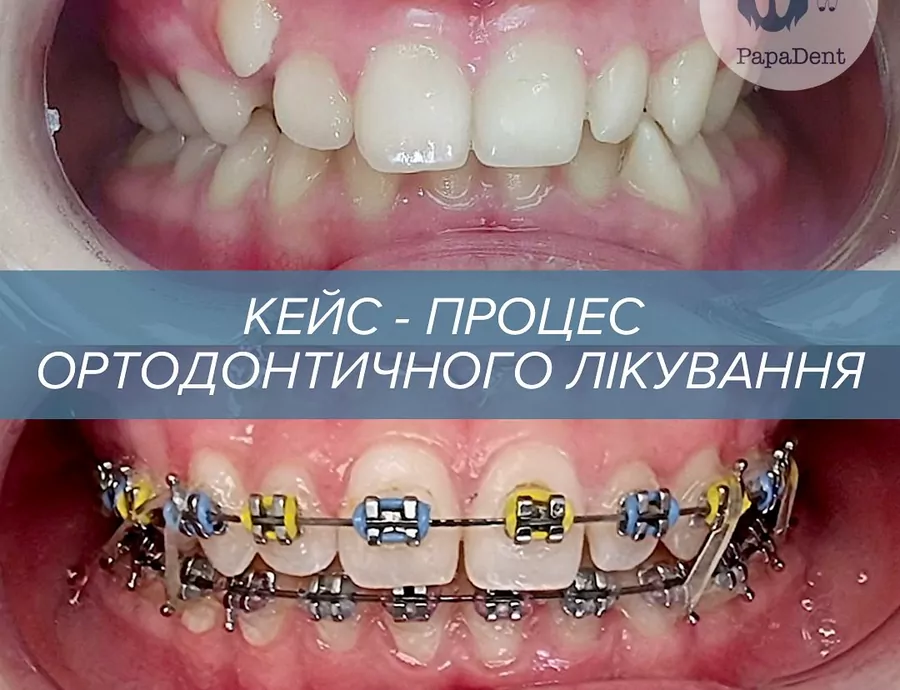 Как работает брекет-система: ответы на частые вопросы