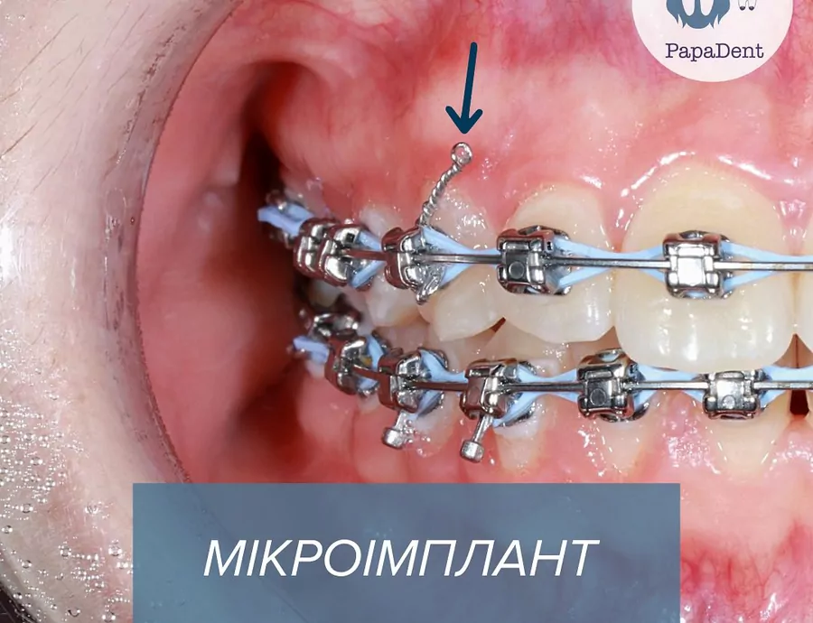 Ортодонтические микроимпланты: точка опоры для движения зубов