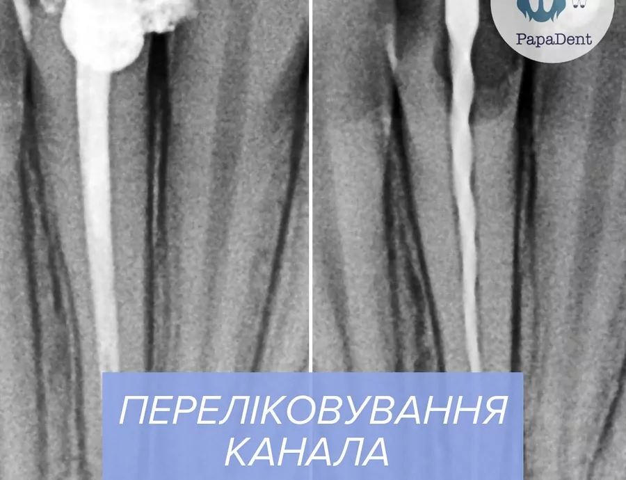 Переліковування кореневих каналів: коли воно потрібне