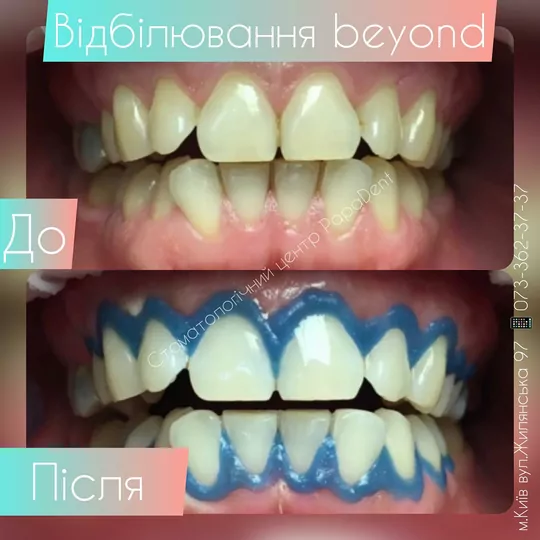 Відбілювання Beyond: до і після