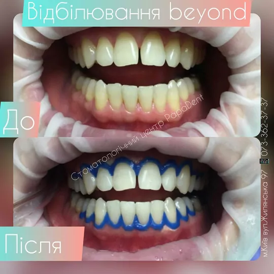 Відбілювання Beyond: до і після
