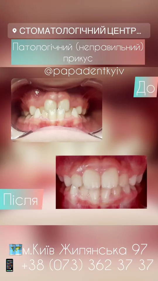 Лікування патологічного прикусу